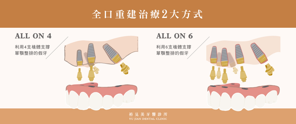 全口重建2大方式:ALL-ON-4、ALL-ON-6