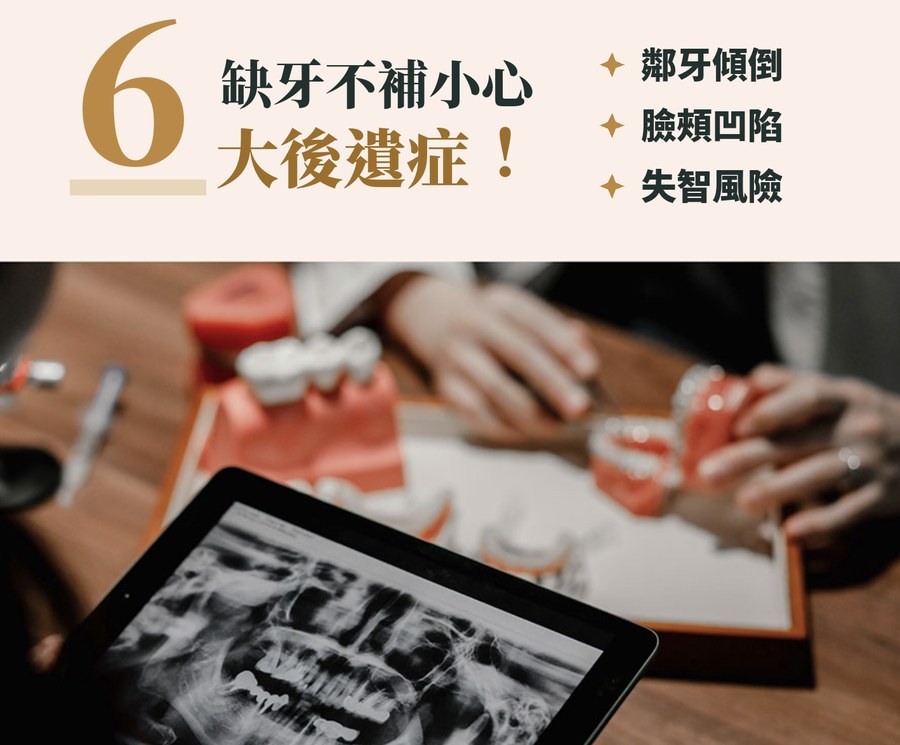 缺牙不補會怎樣？小心 6 大後遺症與失智風險，缺牙多久要補一次看｜裕見美牙醫醫師專欄
